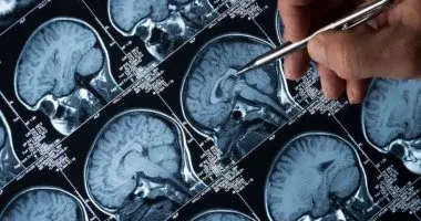 دراسة طبية حديثة تكشف عن عشر حالات صحية قد تشير إلى احتمال تطور مرض الزهايمر قبل سنوات عديدة من التشخيص الرسمي