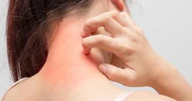 دراسة علمية حديثة تكشف أهمية قرص الفيتامين في السيطرة على تطور الصدفية وتخفيف أعراضها المؤلمة